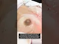 Menambah Volume dan Kekencangan Payudara dengan Breast Enhancement || NOVI'S CLinic
