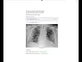 Covid-19 - X-Ray Classification