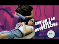 Erbium YAG Laser Resurfacing