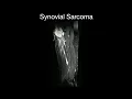 Synovial Sarcoma