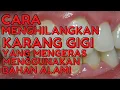 Download Lagu Cara Menghilangkan Karang Gigi yang Sudah Mengeras Dengan Bahan Alami