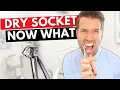 DRY SOCKET - Pain after tooth extraction causes and cure