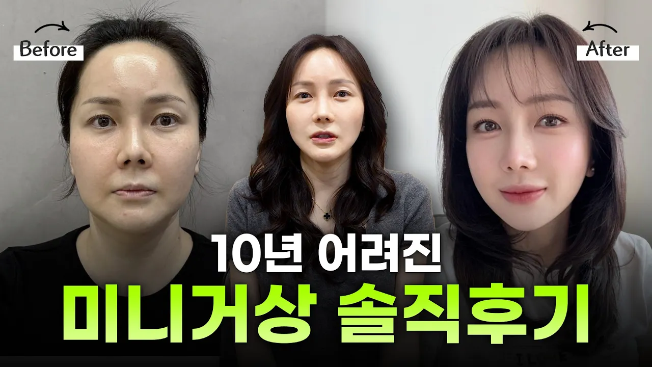 40대미니거상후기, 엄마가 아닌 나를 다시 찾고 싶었어요!ㅣ디에이성형외과ㅣ40대미니거상회복후기