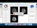 Brain Tumor Detection and Classification MATLAB project