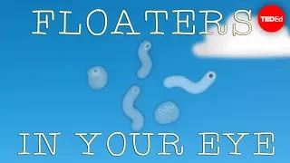 what are those floaty things in your eye michael mauser