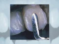 Tooth colored restoration
