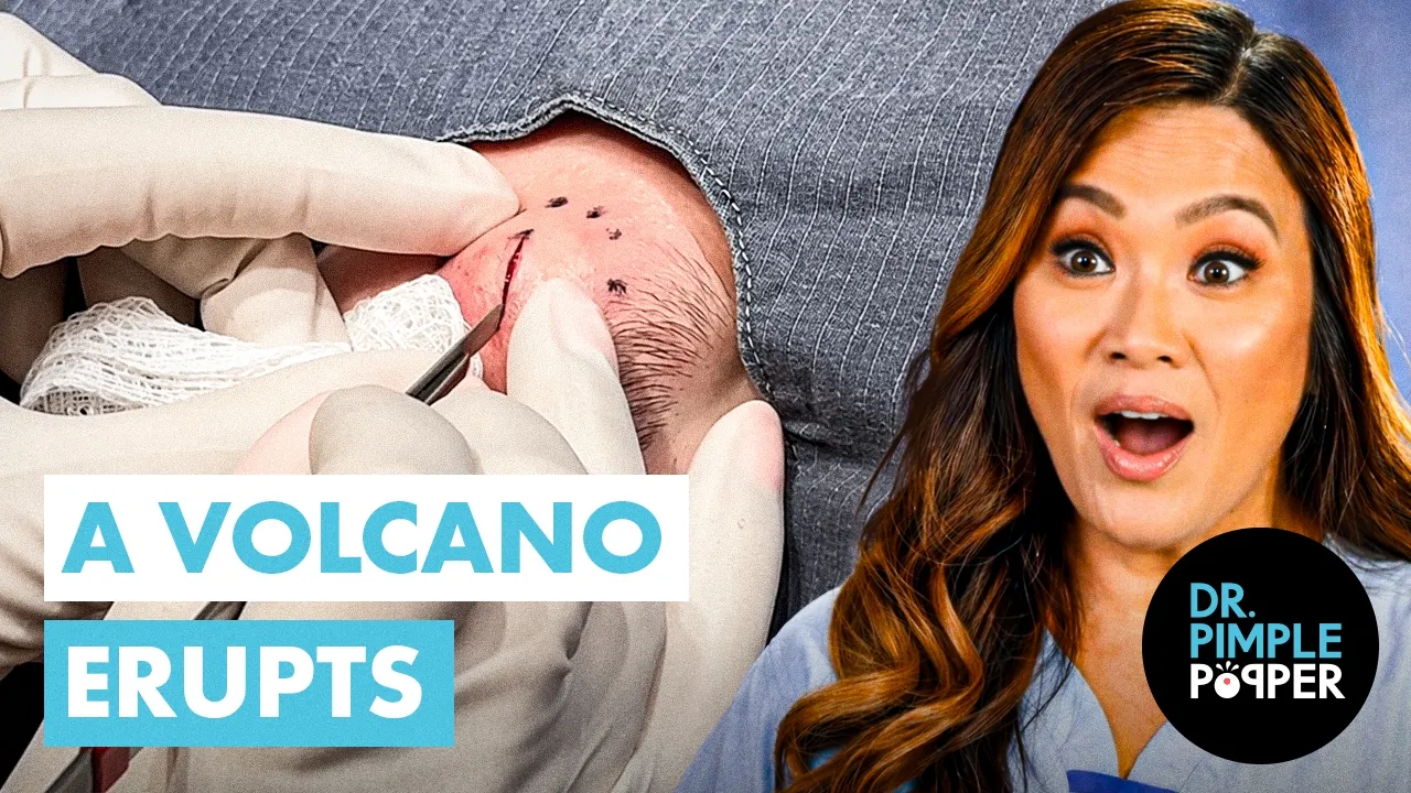 A Volcano ERUPTS in Front of Dr Pimple Popper! Facial Epidermoid Cyst Procedure
