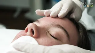Treatment with Revitalize Pure and Revitalize Vitamins - Active acne