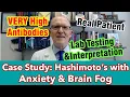 Case Study Hashimoto s with Anxiety Fatigue Brain Fog REALLY high thyroid antibodies