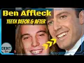 Ben Affleck teeth then and now before and after surgery tooth gap transformation Hollywood Veneers