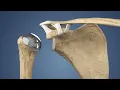 Total Shoulder Replacement Surgery Medical Animation