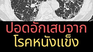 โรคหนังแข็งคืออะไร และเกิดจากสาเหตุใด