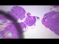 Ask a Pathologist What is a Polyp