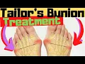 Tailor's Bunion [Bunionette]: Pads, Correctors, Treatment \u0026 Surgery!
