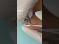 Download Lagu INGROWN TOENAIL 🦶 hack DIY - Worked for Me !