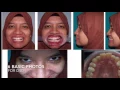 DSD Full Mouth Rehabilitation Planning