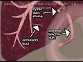 Duct of Luschka Accessory Bile Duct Leakage Animation by Cal Shipley M D