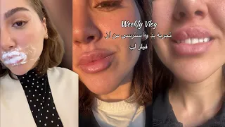 یک هفته ی پر استرس از فیلر لب و دوباره انزیم زدن که بره فقط برهههه 