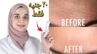 اسرع طريقة للتخلص من الحبوب تحت الجلد والحبوب البيضاء في ٣ ايام فقط 