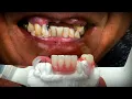 How to Combine a Denture and Flexible Partial for a Stellar Restoration for a Patient