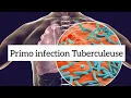 Download Lagu 🔻Comprendre LA PRIMO INFECTION TUBERCULEUSE en 20 min !! 🔥🔥 | khadidja ferdj