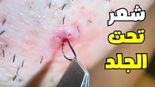 شاهد كيف يتم إزالة شعر تحت الجلد | وتعرف علي الأسباب وطرق العلاج _Ingrown hair removal (satisfaction