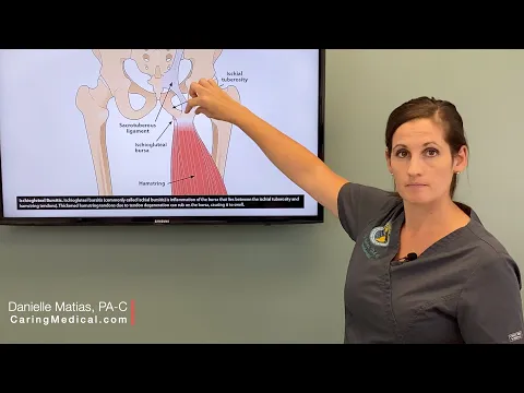 Ischiogluteal Bursitis & Hamstring Tendinopathy- When do we use Prolotherapy?