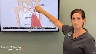 Ischiogluteal Bursitis Hamstring Tendinopathy - When do we use Prolotherapy