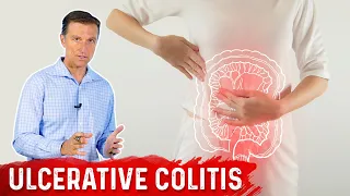 What is Ulcerative Colitis - Causes Symptoms Treatment by Dr Berg