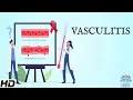 Vasculitis Everything You Need To Know