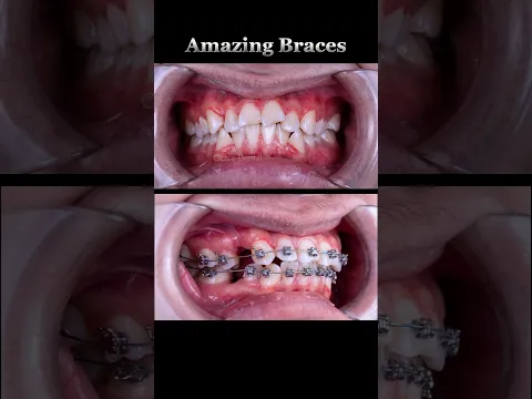 Braces transformation: From crowded teeth to aligned #braces #orthodontics #dentist #teeth #brakets