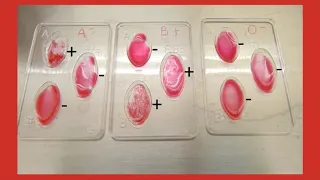 Blood Typing To Determine Paternity 