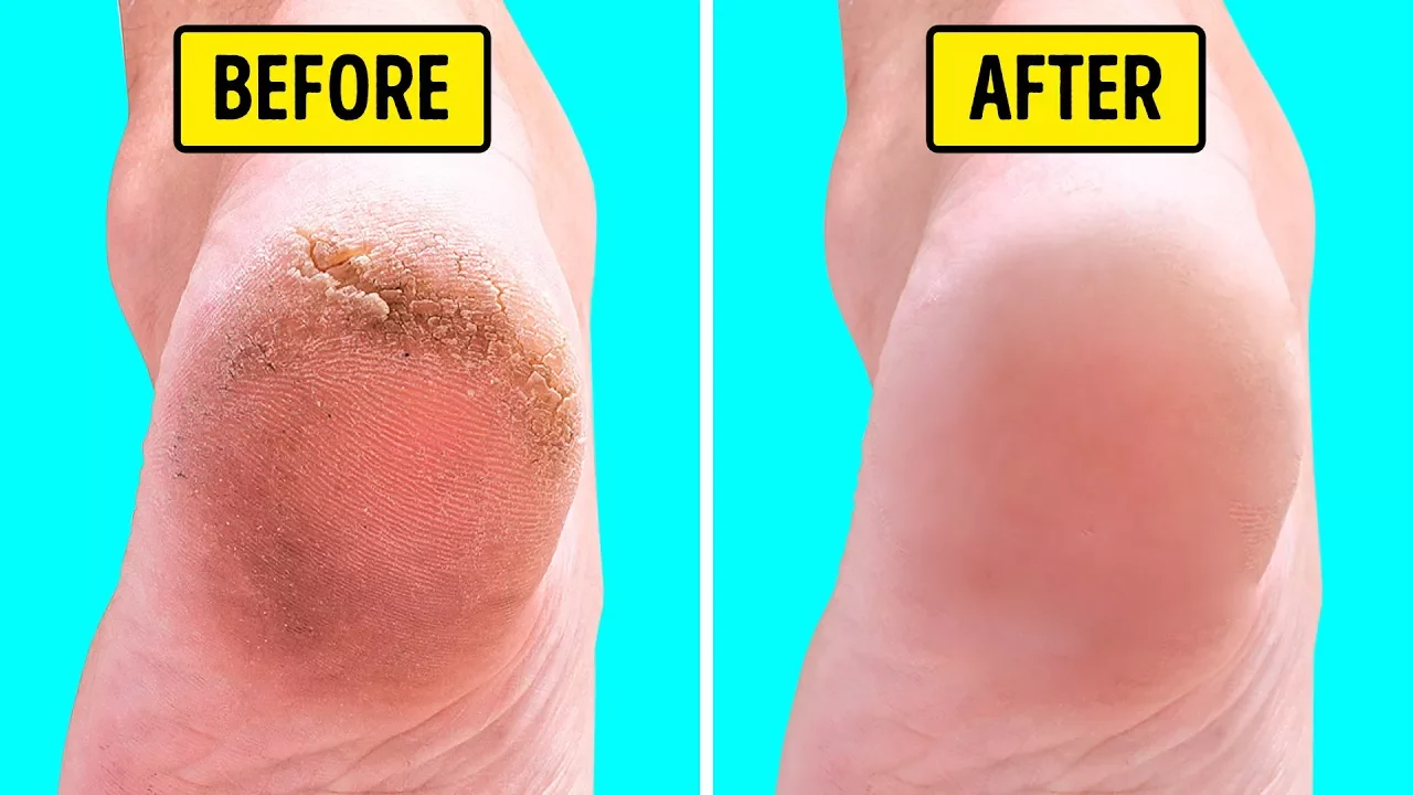 DIY Skin Peel | Healing Cracked Heels !!