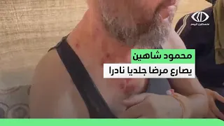 معاناة محمود شاهين من مخيم جباليا المصاب بمرض جلدي نادر انتشر في جسده دندنها