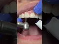 TAKING BRACES OFF🎉🎊 #reels #braces #bracesoff #orthodontist #shullmanorthodontics