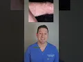 Derm s tip for itchy finger bumps Dyshidrotic Eczema
