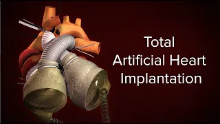 medical animation total artificial heart implantation cincinnati childrens