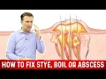 The Deeper Cause of an Eye Stye Boil or Abscess - Eye Infection Stye