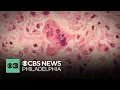 Delaware County launches measles immunization campaign for back-to-school