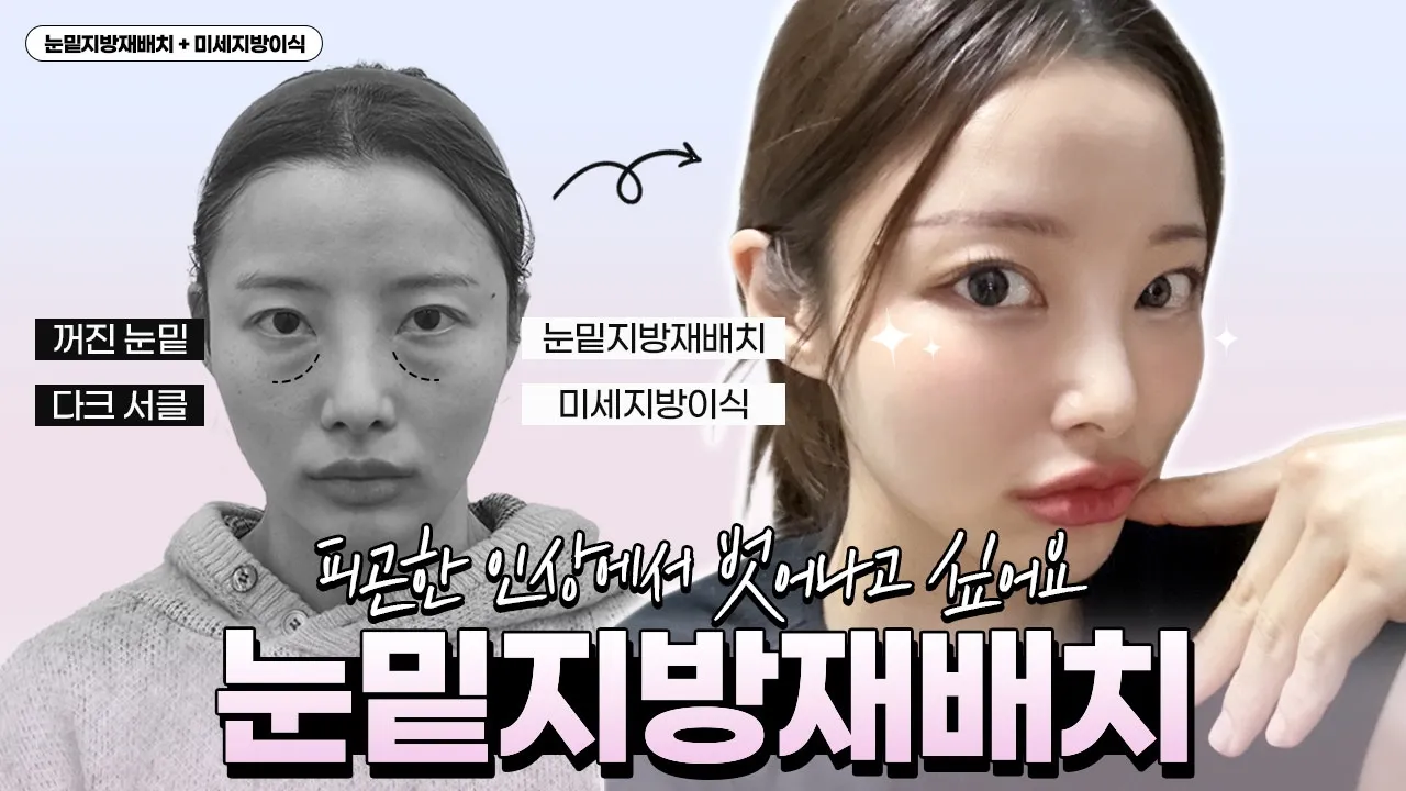 [VLOG] 👁‍🗨꺼진 눈밑과 피곤한 인상에서 벗어나고 싶어요! 💖 눈밑지방재배치 + 미세지방이식