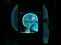 PLK - ARAI (Explicit)