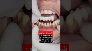 حماية الاسنان مع تلبيسات زيركون ممتازة 