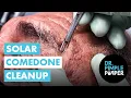 Download Lagu Solar Comedone Cleanup