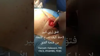 شاهد الفتق الاربي اثناء العملية الدكتور حمزة الحلواني 