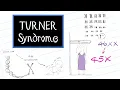 What is Turner Syndrome HealthSketch