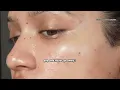 How to get rid of TINY BUMPs on face 🎀 at home NATURALLY || Closed comodones & Fungal acne