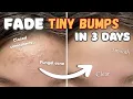 How to get rid of TINY BUMPs on face at home NATURALLY Closed comodones Fungal acne