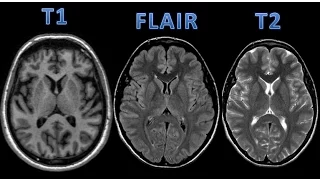 RM do Crânio T1, T2 e FLAIR