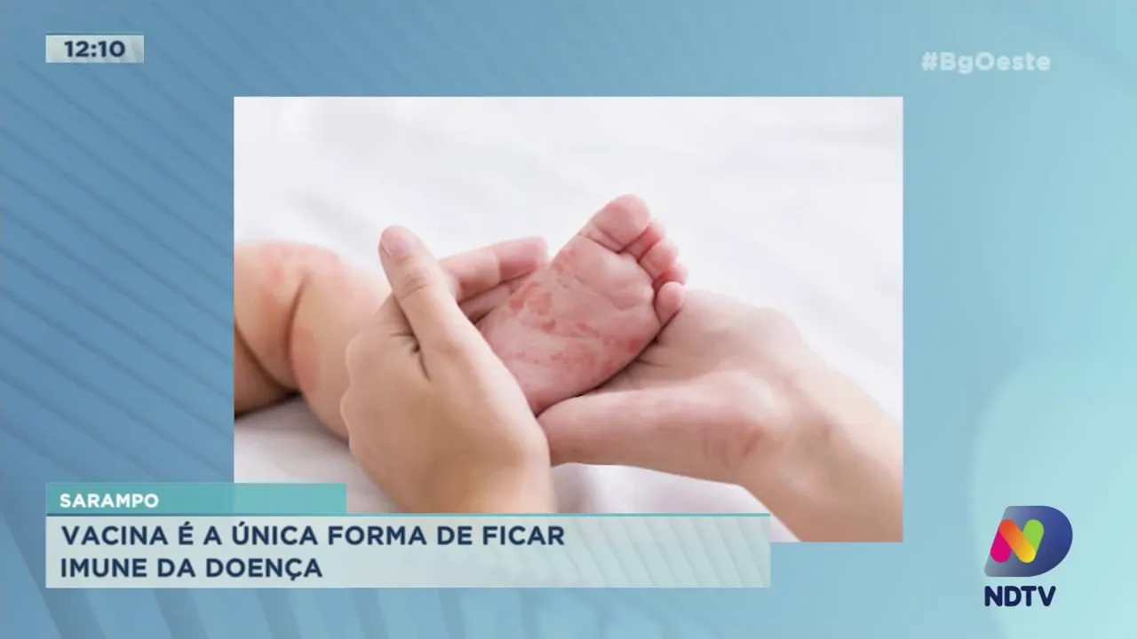 Sarampo: Vacina é a única forma de ficar imune a doença