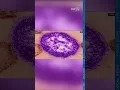 Measles case in Kentucky Here s what you should know